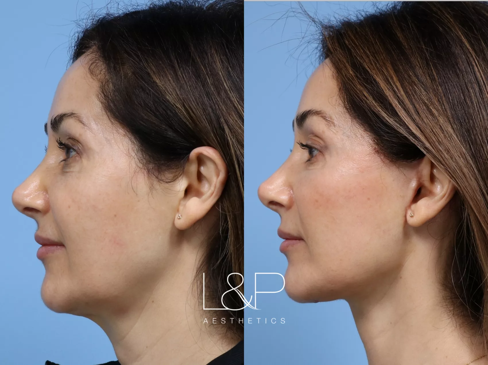 facelift-neck-lift-233-left-side-detail