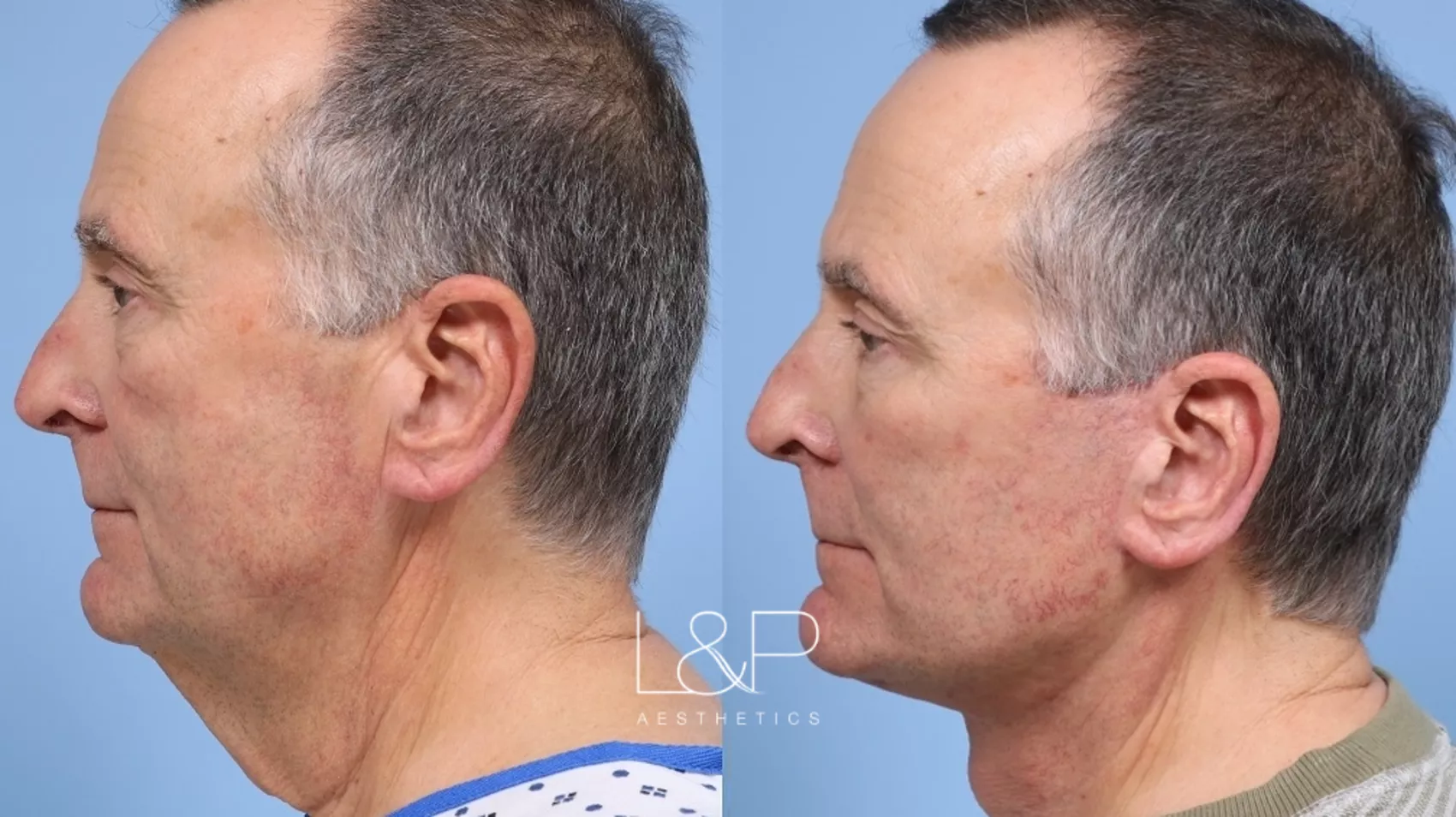 facelift-neck-lift-278-left-side-detail